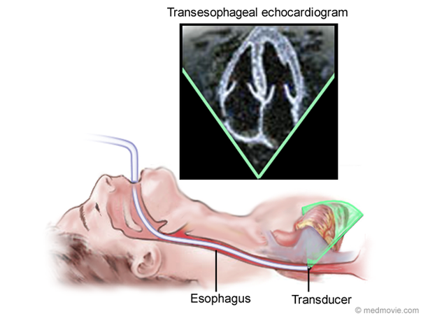 Transesophageal Echocardiography | Cardiovascular Consultants of