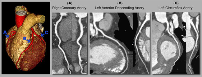 Ct Angiography Heart